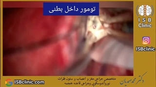 تومور داخل بطنی