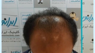 نمونه کاشت مو