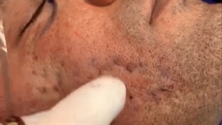 فیلم از بین بردن جای جوش با نانوفت و سابسیژن به صورت همزمان