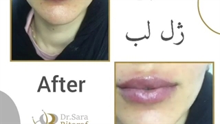 حجیم کردن لب با تزریق