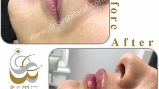زیبایی با تزریق ژل لب