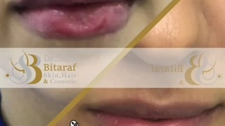 تزریق ژل لب زیبا