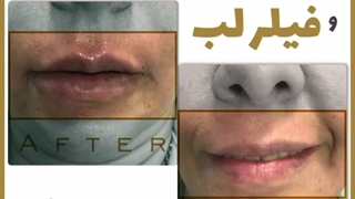 از بین بردن خط خنده و فیلر لب