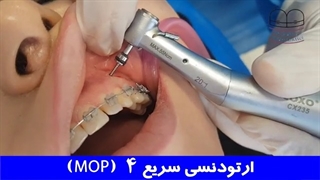 ارتودنسی سریع 4 | دکتر احسان مهریزی