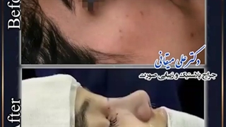 فیلم راینوپلاستی | دکتر میقانی