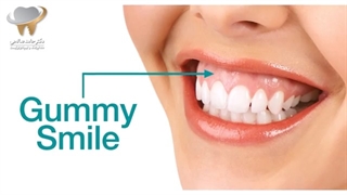 کاربرد لیزر در درمان لیفت لثه | دکتر حامد صالحی