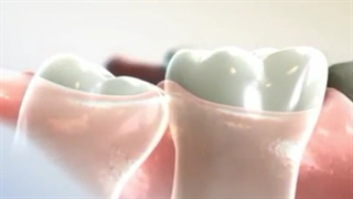 دندان عقل نهفته