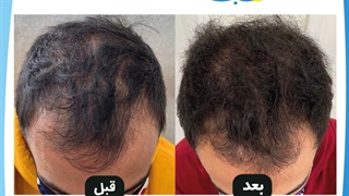 پی آر پی (PRP) ارتودنسی