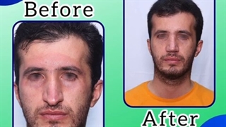 عمل جراحی زیبایی بینی آقایان