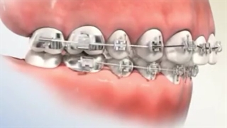 ارتودنسی دندان زیبایی