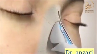 انیمیشن جراحی رینوپلاستی