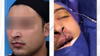 جراحی شکاف لب مادرزادی | فوق تخصص جراحی پلاستیک | دکتر عبدالرضا روئین تن