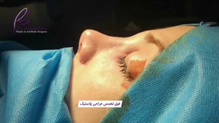 نتیجه فوق العاده جراحی بینی(لیپوماتیک فرمانیه)