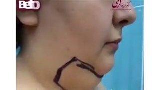 نتیجه شگفت انگیز لیپوماتیک غبغب و زاویه فک