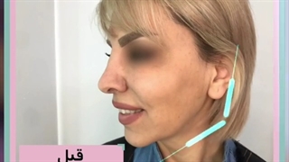 مراحل لیفت و جوانسازی صورت با نخ
