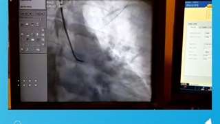 آنژِیوپلاستی اورژانسی در بیماری با مصرف آمفتامین