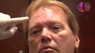 آموزش تزریق بوتاکس به پیشانی دندان شیری