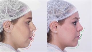 تاثیر ارتودنسی روی صورت | دکتر داودیان