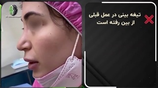 جراحی ترمیمی بینی با افتادگی شدید نوک | دکتر باستانی نژاد