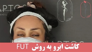 کاشت ابرو به روش FUT