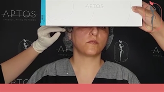 انجام همزمان نخ آپتوس و فیلر