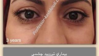 جراحی تیروئید چشمی | پروفسور کشکولی | فوق تخصص جراحی پلاستیک چشم