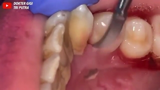 جرمگیری دندان مشهد