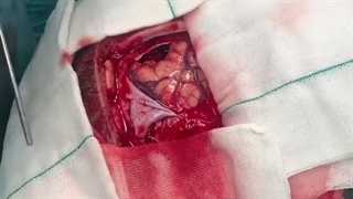 جراحی تومور مننژیوم مغزی