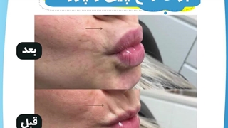 تزریق فیلر برای رفع چین و چروک کلینیک لیزر