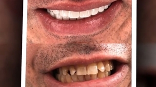 نمونه کارهای زیبایی دندان- دکتر ندا هادی