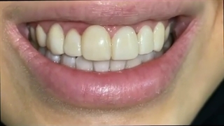 اصلاح طرح لبخند