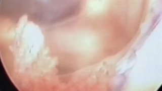 عمل جراحی آندوسکوپی ‌مغز