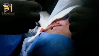 قبل و بعد عمل زیبایی پلک بالا