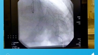 ّآنژیوپلاستی رگ بیمار با انسداد شدید