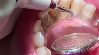 جرمگیری دندان