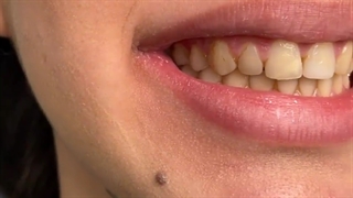 کامپوزیت دندان