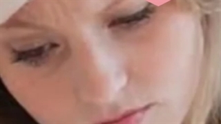 روش های درمان لک صورت در کلینیک بین المللی الهیه تهران هایفوتراپی