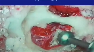 کلستاتوم و فلج عصب فشیال چیست و چگونه درمان می شود