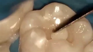 ترمیم پوسیدگی دندان