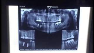 کاشت 2 واحد ایمپلنت دندان بصورت هم زمان توسط دکتر شهرام اسعدی کربوکسی تراپی