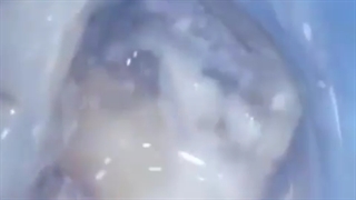 ترمیم پوسیدگی دندان