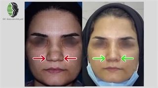 نتیجه جراحی ترمیمی بینی زینی شکل | دکتر باستانی نژاد