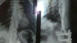 شکستگی ستون فقرات