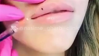 تزریق فیلر لب برای حجم دهی