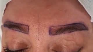 کاشت ابرو دائمی در یک جلسه| کلینیک ابروان