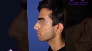 جراحی با اصلاح شکستگی های بینی