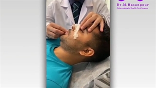 جراحی بینی استخوانی غضروفی