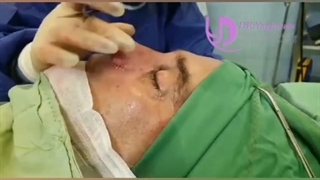 رفع سه ایراد اساسی بینی تنها با جراحی بینی در یک نوبت