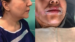 فیلم جراحی مینی لیفت صورت
