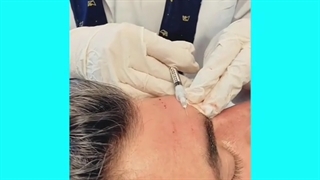 از بین بردن خطوط پیشانی با روش های ترکیبی